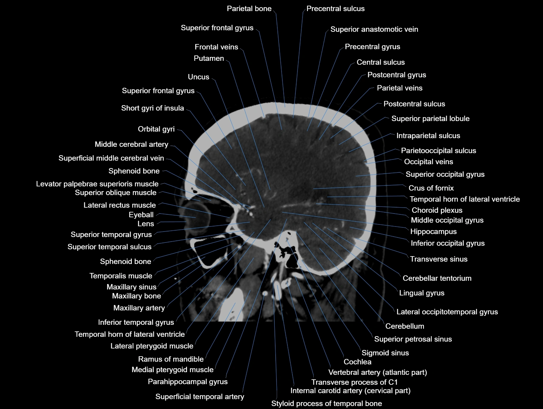 CT scan brain sagittal cross sectional anatomy image-img-00001-00024.webp